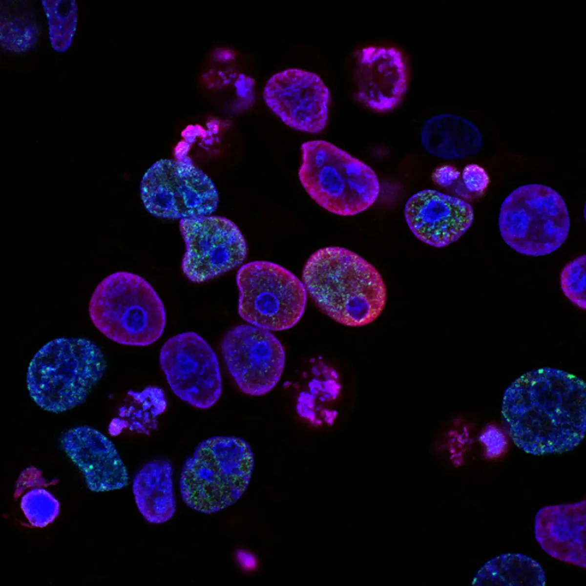 Demystifying Follicular Lymphoma Blood Cancer