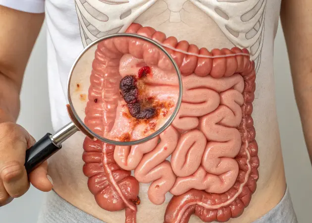 What Is Celiac Disease? A Comprehensive Guide